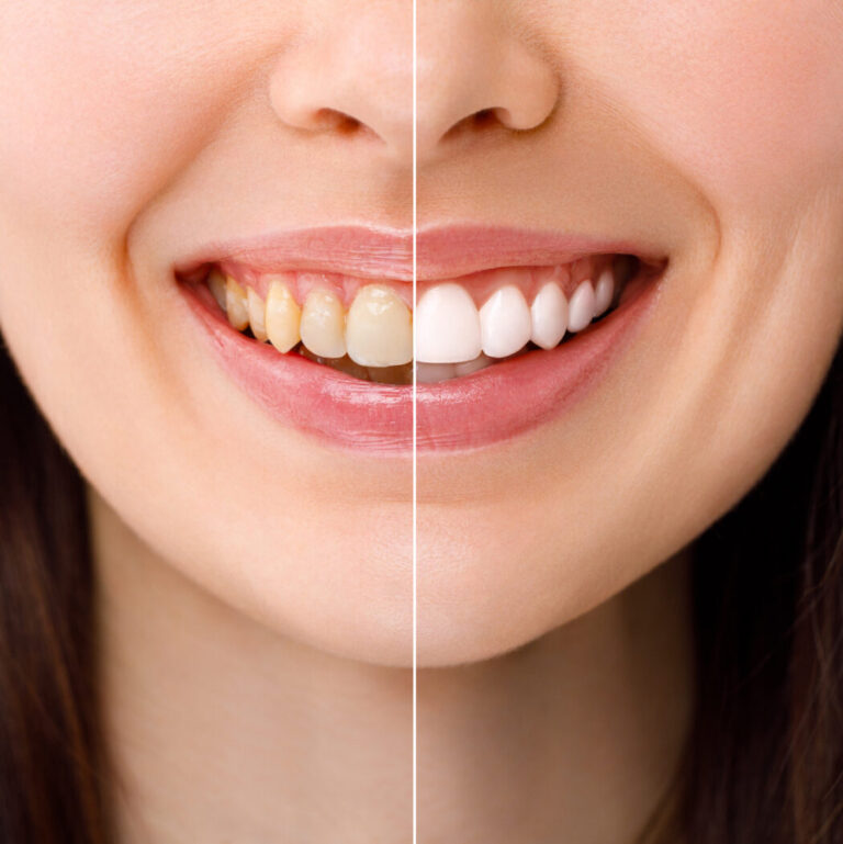 Can Teeth Whitening Cause Sensitivity?