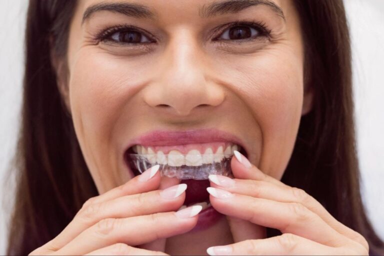 How Do Invisalign Aligners Work?