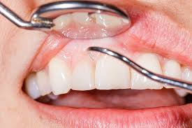 How Professional Cleanings Help Combat Gum Disease