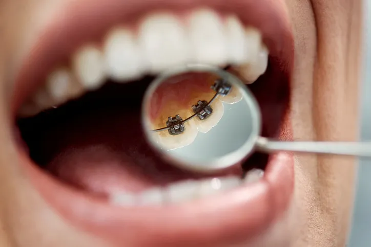 How to Take Care of Braces for a Successful Treatment