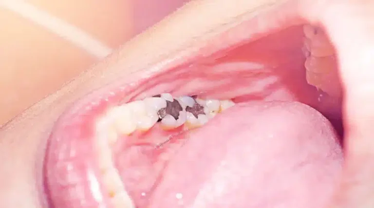 How Pediatric Dentists Address Common Dental Issues in Children