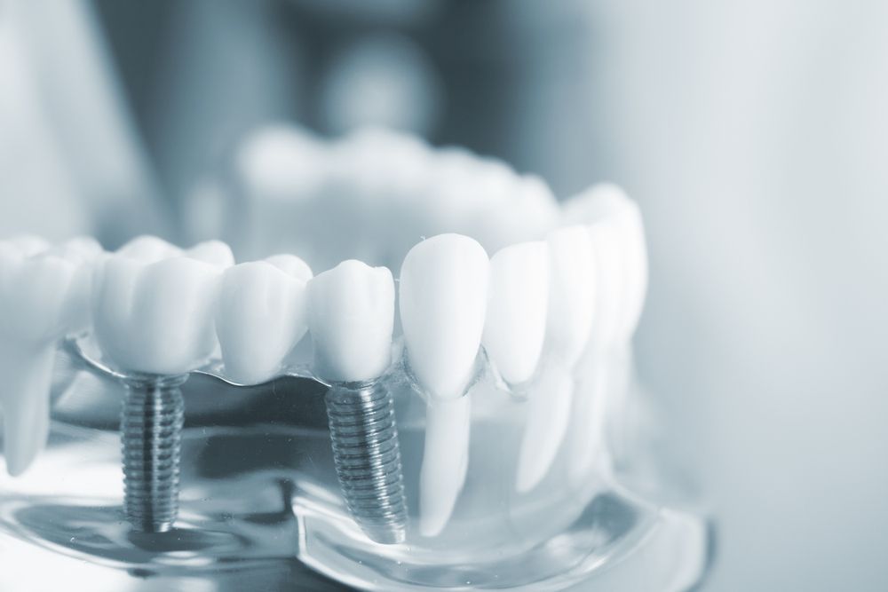 How to Prepare for Your First Dental Implant Consultation