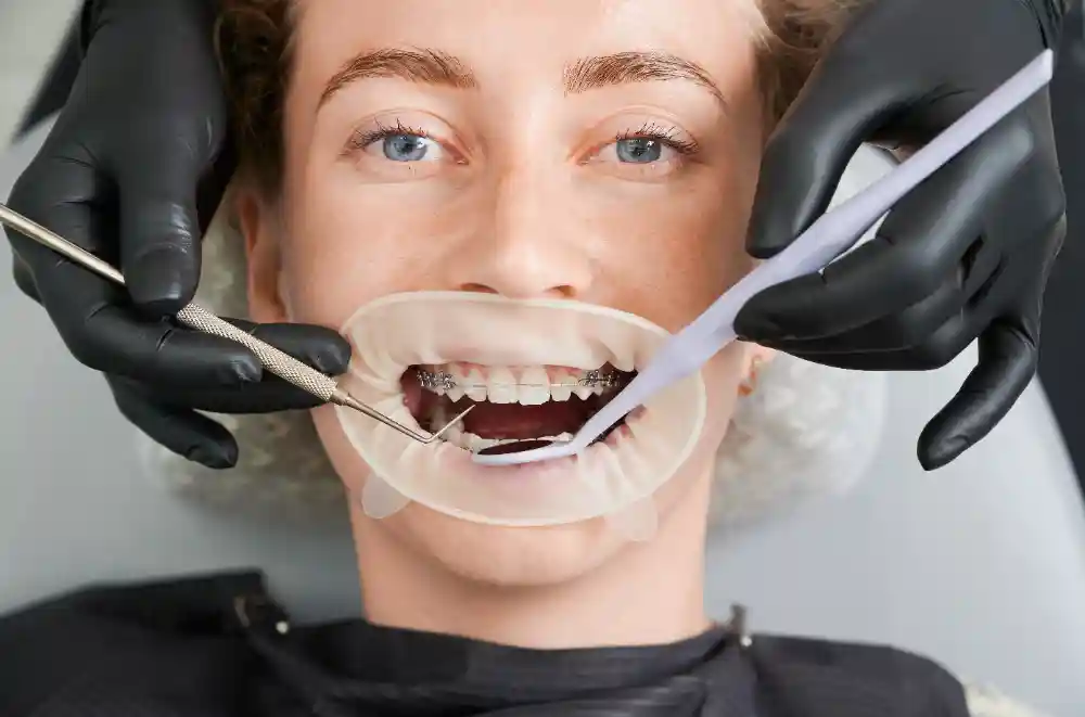 The Link Between Tooth Decay and the Need for Extractions
