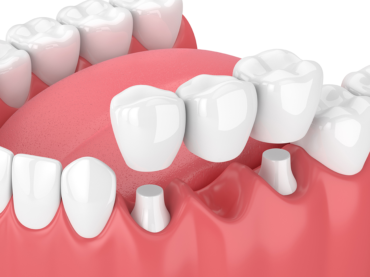 The Process of Getting Crowns and Bridges Explained