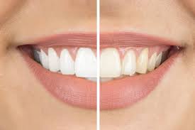 Teeth Whitening Options for Sensitive Teeth