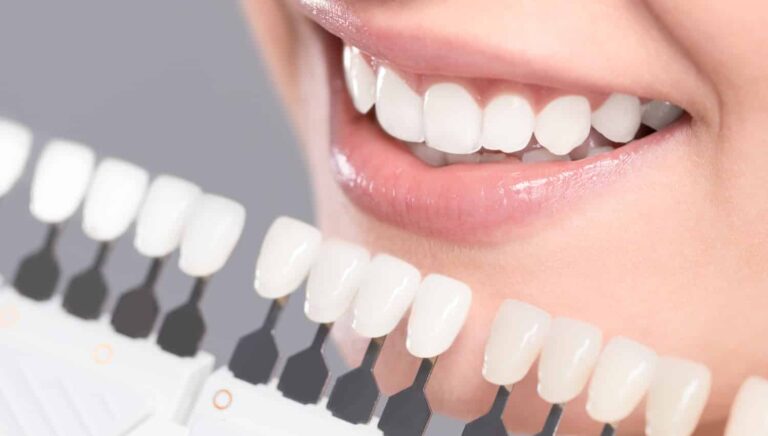 Understanding How Teeth Whitening Works