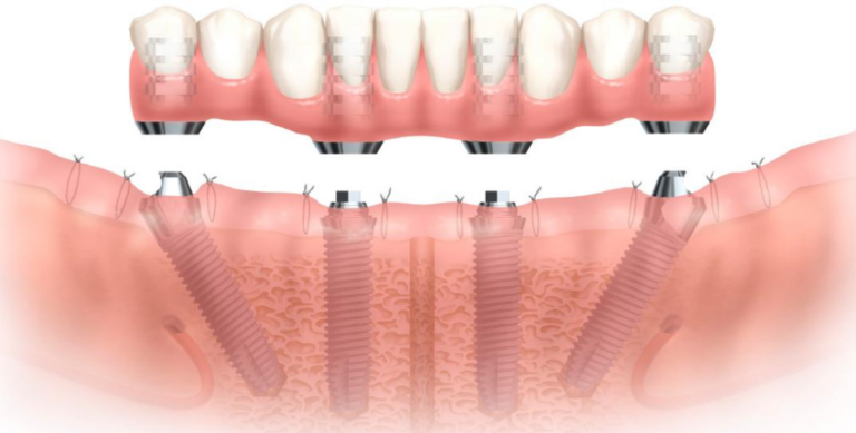 Benefits of Dental Implants for Tooth Replacement